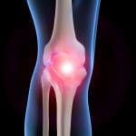 Acupuncture for ostio-arthritis of the knee